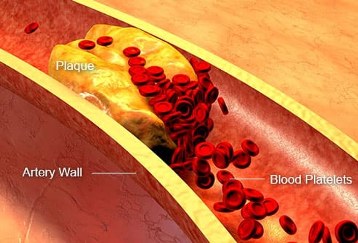 Stroke and Heart Disease