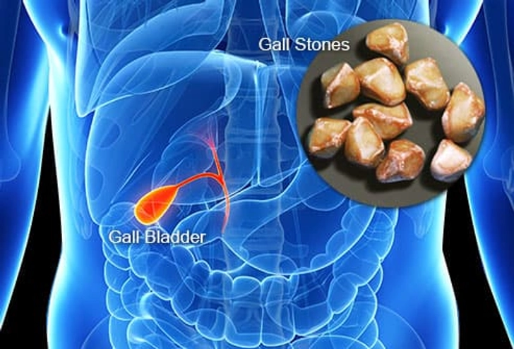 Gallbladder Disease Gallbladder Disease