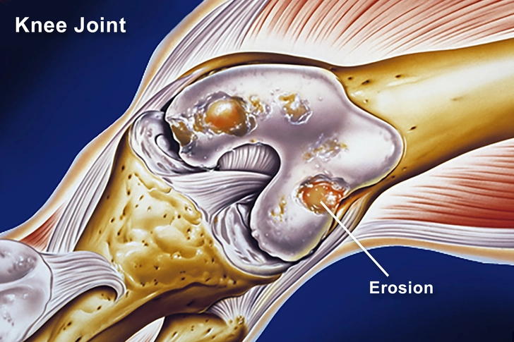 Biologics Can Prevent Joint Damage