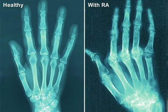 photo of xray of hands with ra