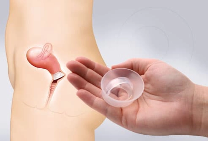 Cervical Cap