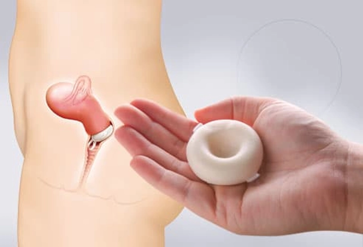 Birth Control Sponge