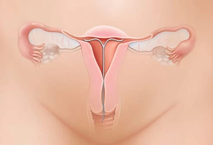 IUD