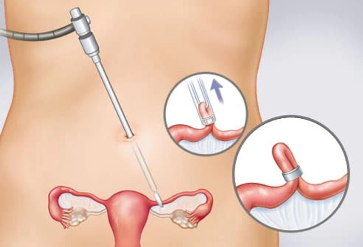 Tubal Ligation