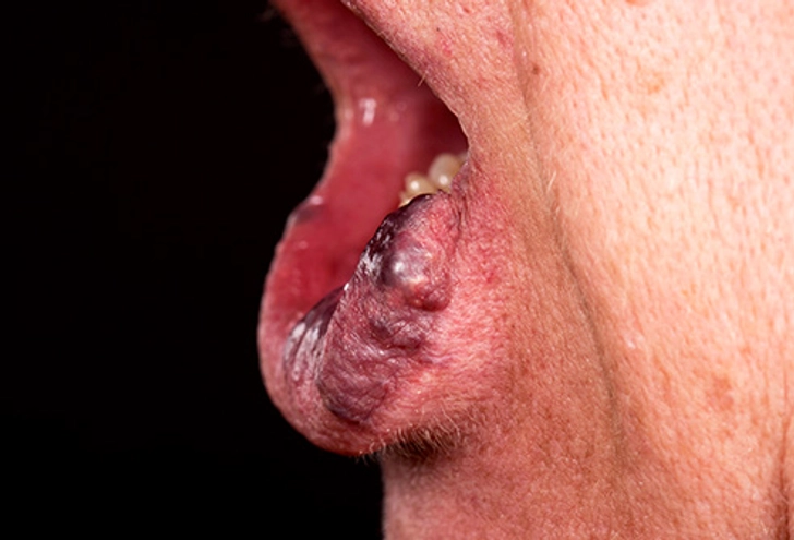 Venous Malformation Venous Malformation