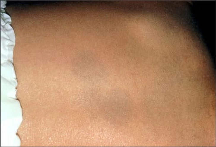 Congenital Melanocytosis