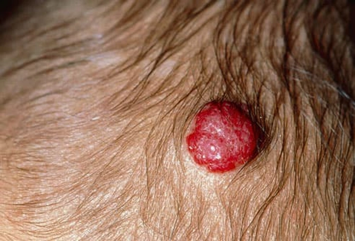 Strawberry Hemangiomas