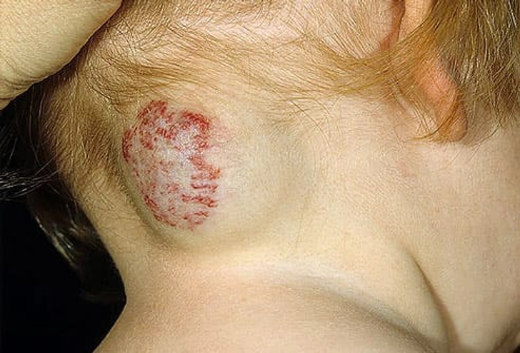 Cavernous Hemangiomas