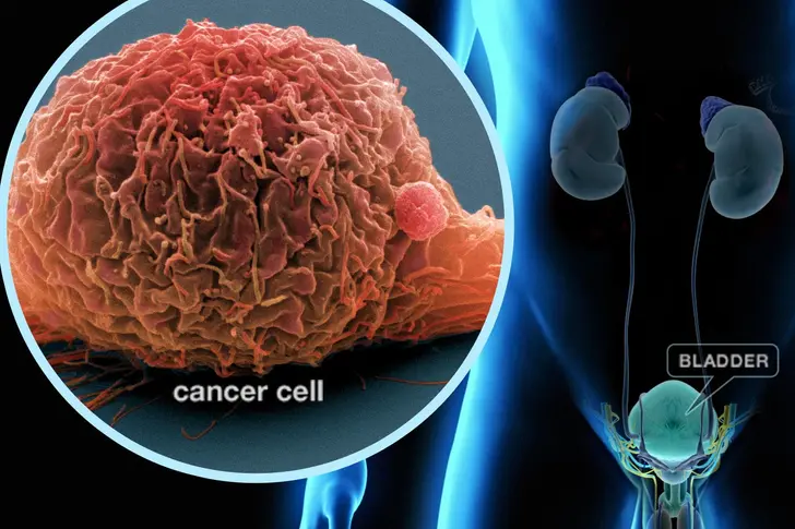 What Is Bladder Cancer? What Is Bladder Cancer?