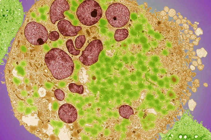 Types of Bladder Cancer Types of Bladder Cancer