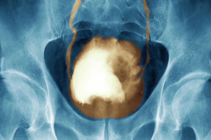 Warning Sign: Bladder Changes Warning Sign: Bladder Changes