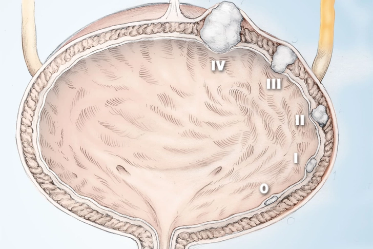 Stages of Bladder Cancer Stages of Bladder Cancer