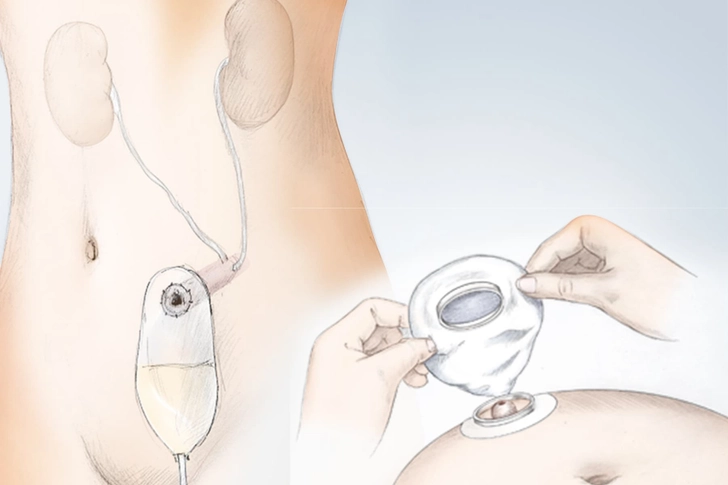 Treatment: After Surgery Treatment: After Surgery