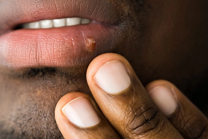 Herpes Simplex