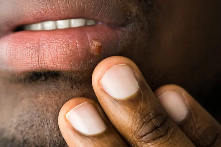 photo of herpes simplex