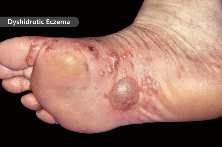 Atopic Dermatitis Atopic Dermatitis