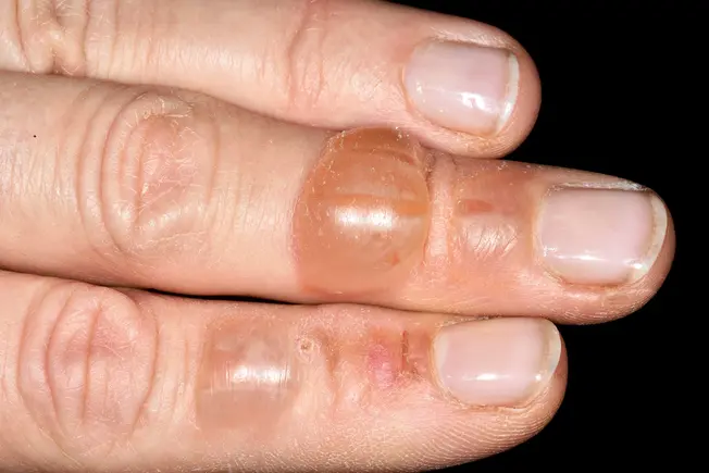 What Are Blisters?