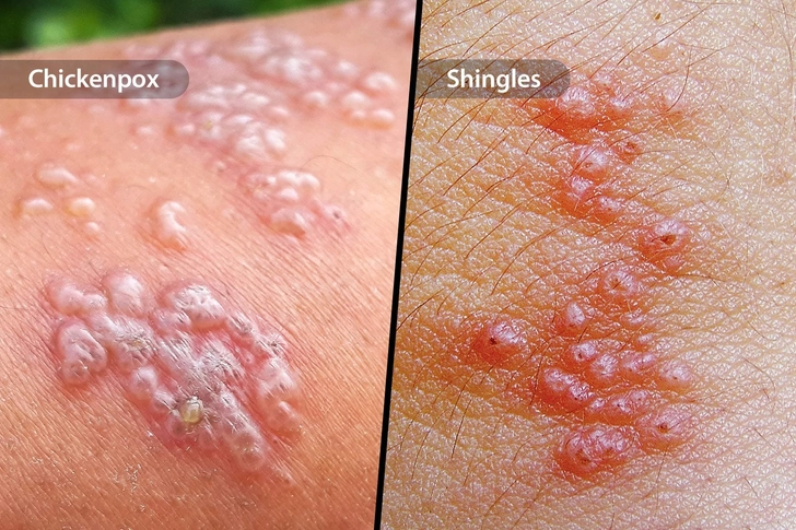 Chickenpox & Shingles