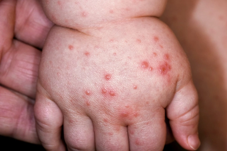 Hand-Foot-and-Mouth Disease
