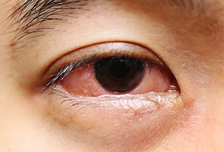 Your Eye Is Inflamed