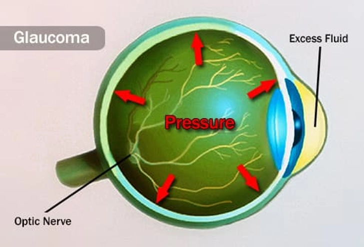 Fluid Is Building Up in Your Eye