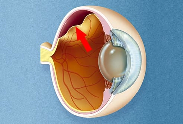 Your Retina Is Damaged Your Retina Is Damaged