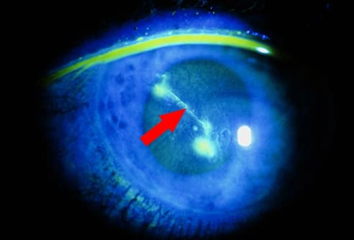 You Scratched Your Cornea You Scratched Your Cornea