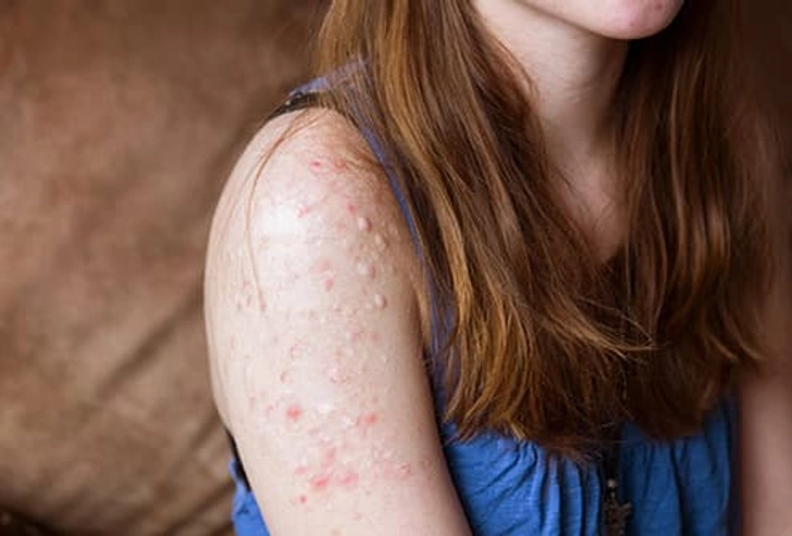 Dermatillomania