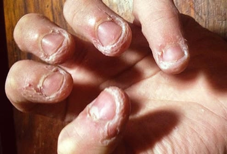 Dermatophagia