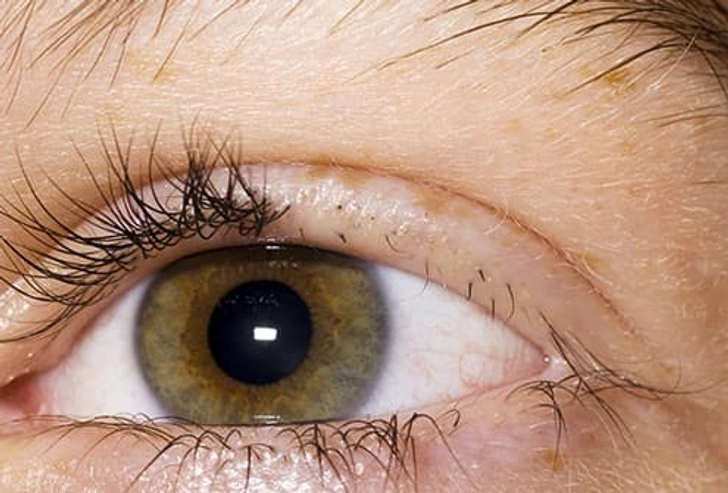 Trichotillomania