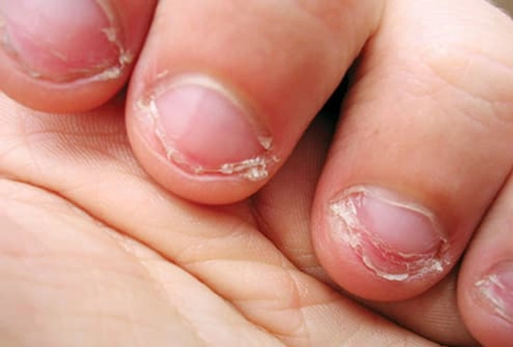 Onychophagia