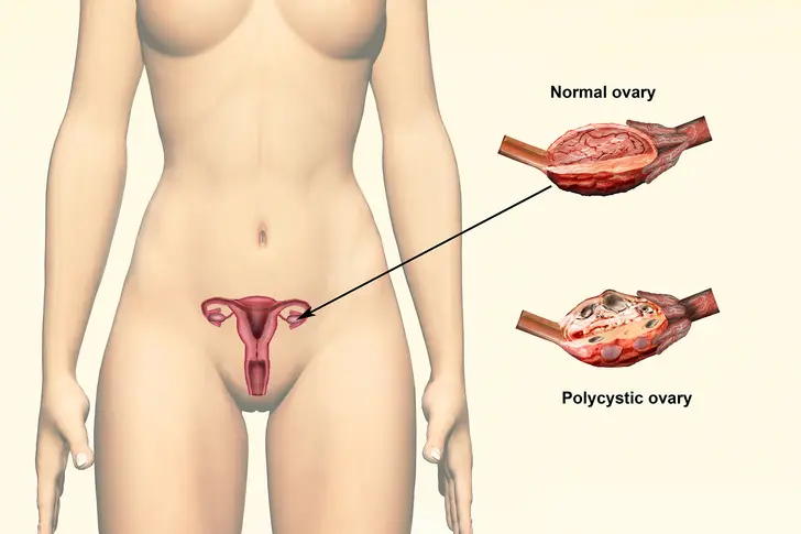 Hormonal Imbalance Hormonal Imbalance