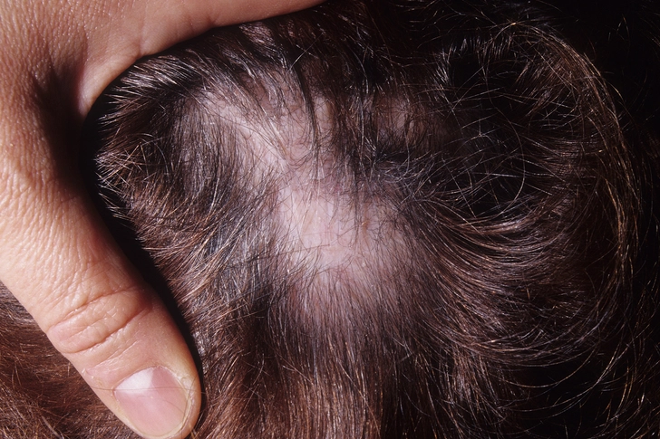 Scarring Alopecia