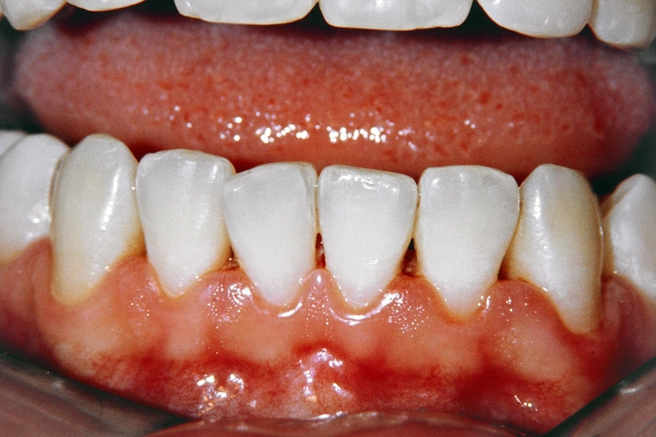 Gums