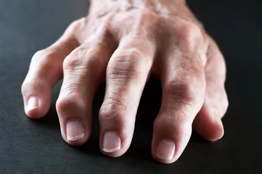 Untreated rheumatoid arthritis can leave you with painful, damaged joints and complications in many parts of your body that can put you at risk for an earlier death. (Photo Credit: iStock/Getty Images)
