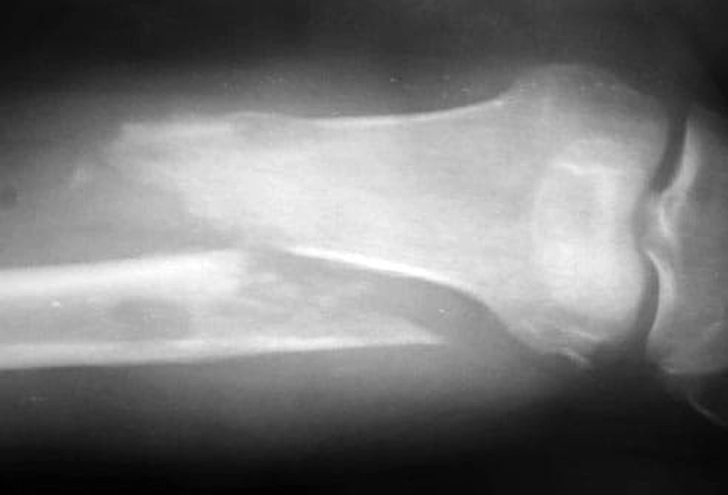 How It Damages Your Bones
