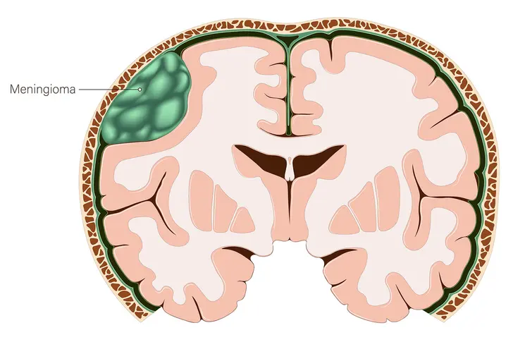 The Challenge of Brain Cancer