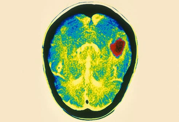 How a Rupture Damages Your Brain