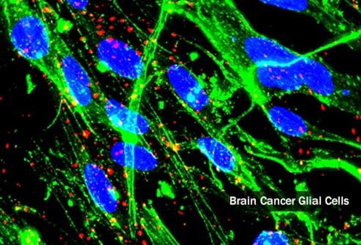 Primary Brain Tumors