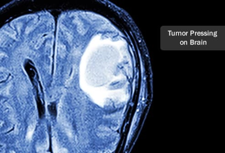 Brain Tumors