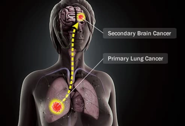 Secondary Brain Cancer