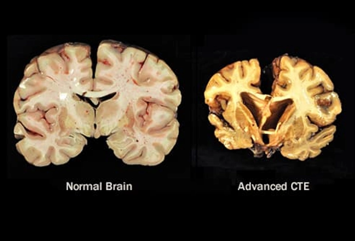 Chronic Traumatic Encephalopathy (CTE)
