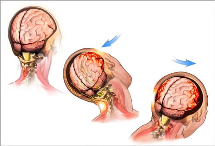 What Is a Concussion? What Is a Concussion?
