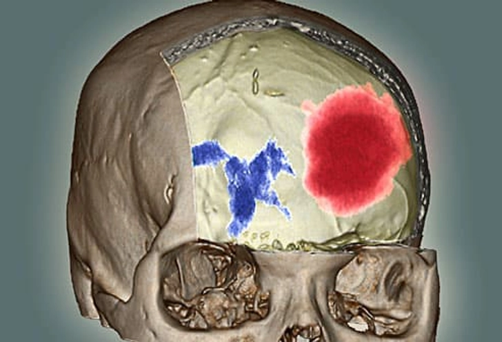 Bleeding in the Brain