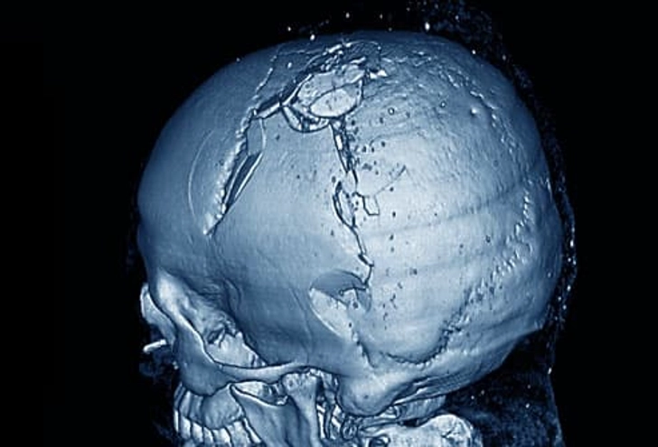 Skull Fractures