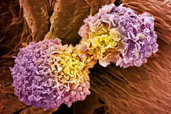 When Cancer Goes Beyond Your Breast When Cancer Goes Beyond Your Breast