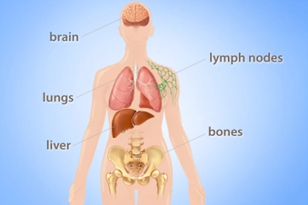 Most Common Places It Spreads