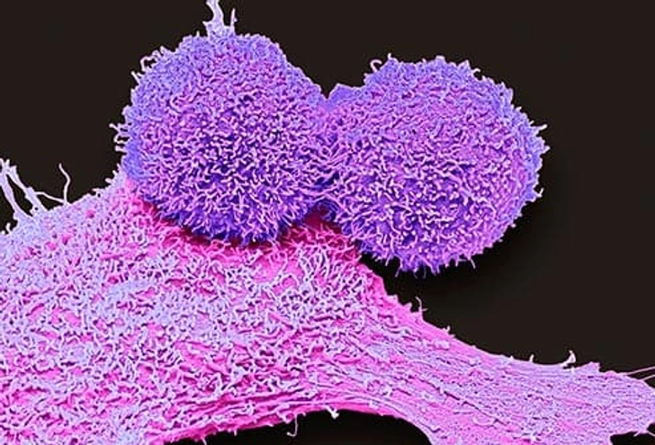 Triple-Negative Breast Cancer