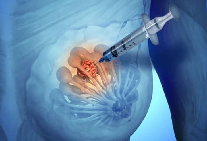 Breast Biopsy