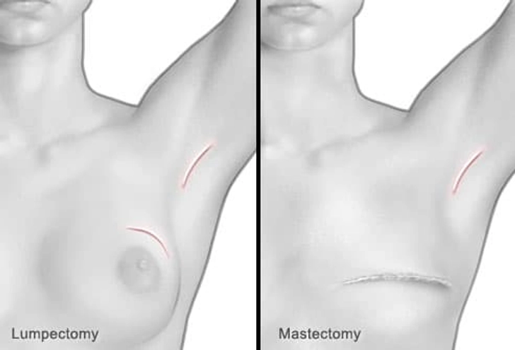 Breast Cancer Surgery Breast Cancer Surgery